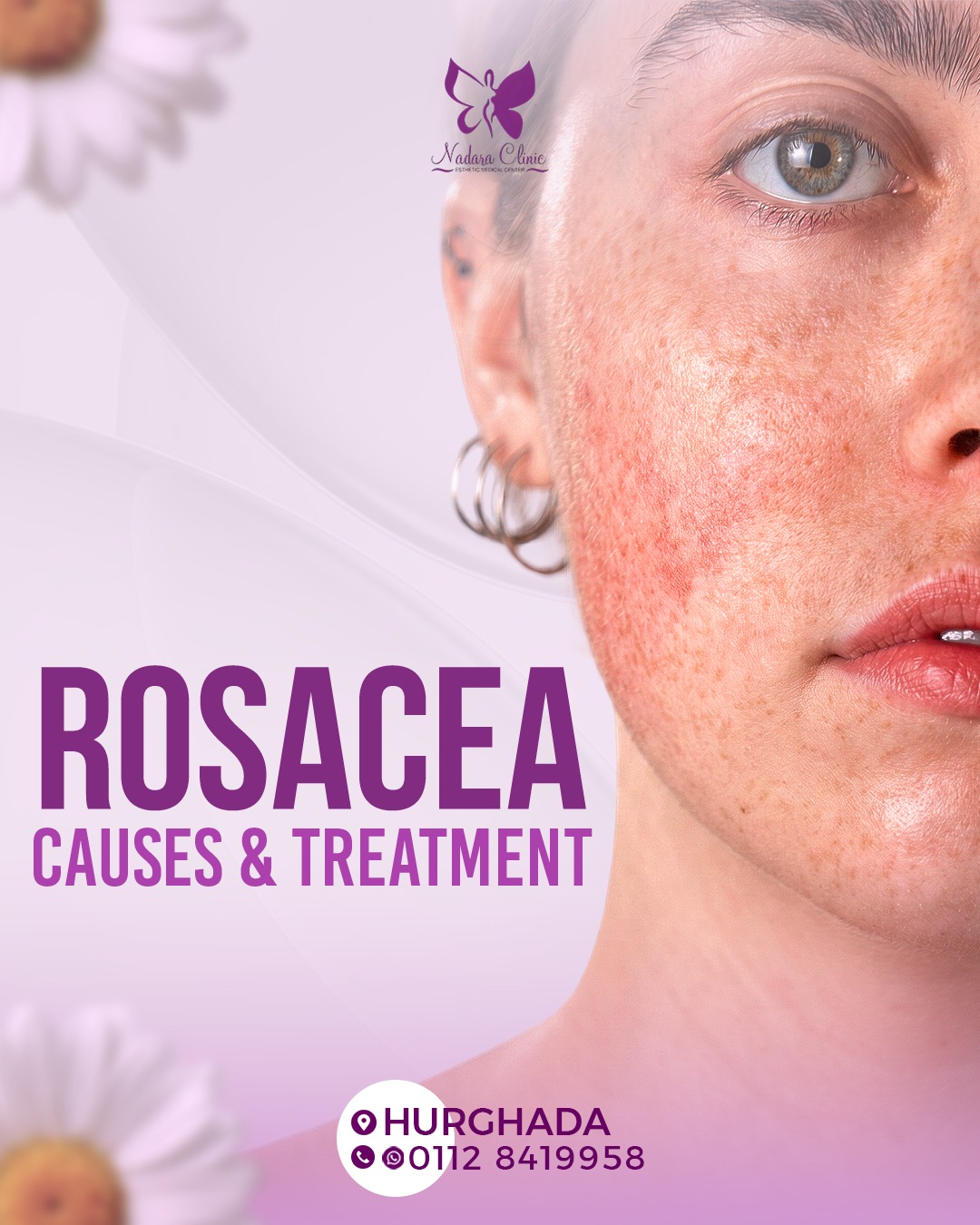 Rosacea: Causes and Treatment Methods in Hurghada